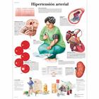 Lehrtafel - Hipertensión arterial, 4006846 [VR3361UU], Herz-Kreislauf-System