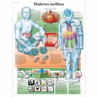 Lehrtafel - Diabetes mellitus, 1001885 [VR3441L], Stoffwechselsystem