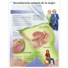 Lehrtafel - Incontinencia urinaria de la mujer, 4006864 [VR3542UU], Gynäkologie