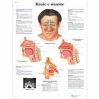 Rinite e sinusite, 4006916 [VR4251UU], Ear, Nose and Throat (ENT)
