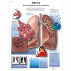 BPCO Broncopneumopatia cronia ostruttiva, 1002021 [VR4329L], 吸烟教育示意图