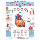 Infarto cardiaco, 1002025 [VR4342L], sistema Cardiovascolare