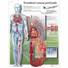 Trombose venosa profonda, 1002037 [VR4368L], sistema Cardiovascolare