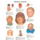 Malattie infantili, 4006974 [VR4741UU], Parasitarias, virales e infecciones bacterianas (Small)