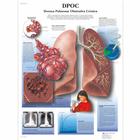 Doença pulmonar obstrutiva crônica, 50x67 cm, Laminado, 1002157 [VR5329L], Sistema Respiratório