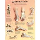 Deformities of the Feet Chart, 1002234 [VR6185L], Skeletal System