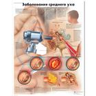 Diseases of the Middle Ear Chart, 1002247 [VR6252L], 耳，鼻，喉