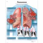 Медицинский плакат "Пневмония", 1002259 [VR6326L], Плакаты по дыхательной системе человека