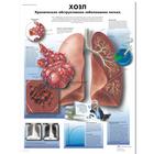 COPD Chart - Chronic Obstructive Pulmonary Disease, 1002262 [VR6329L], 呼吸系统