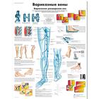 Медицинский плакат "Варикозные вены", 1002276 [VR6367L], Плакаты по системе кровообращения