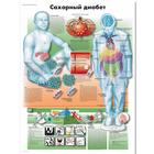 Медицинский плакат "Сахарный диабет", 1002296 [VR6441L], Плакаты по метаболической системе