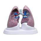 Set di polmoni con patologie, 1018749 [W33371], Modelli di Polmone