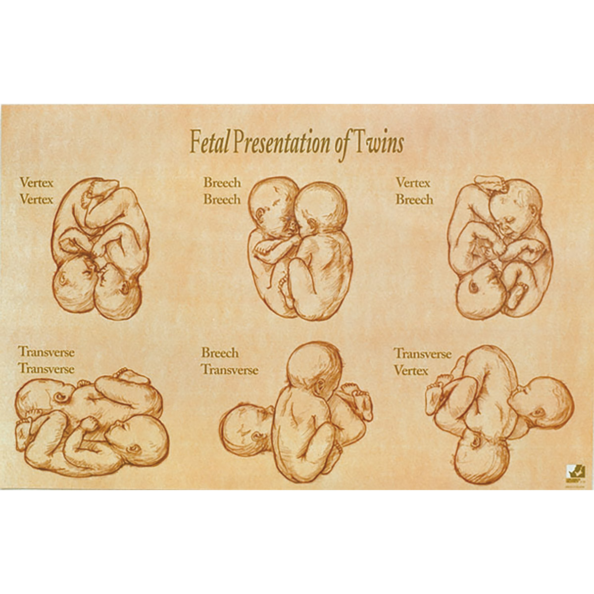 twin presentation in pregnancy