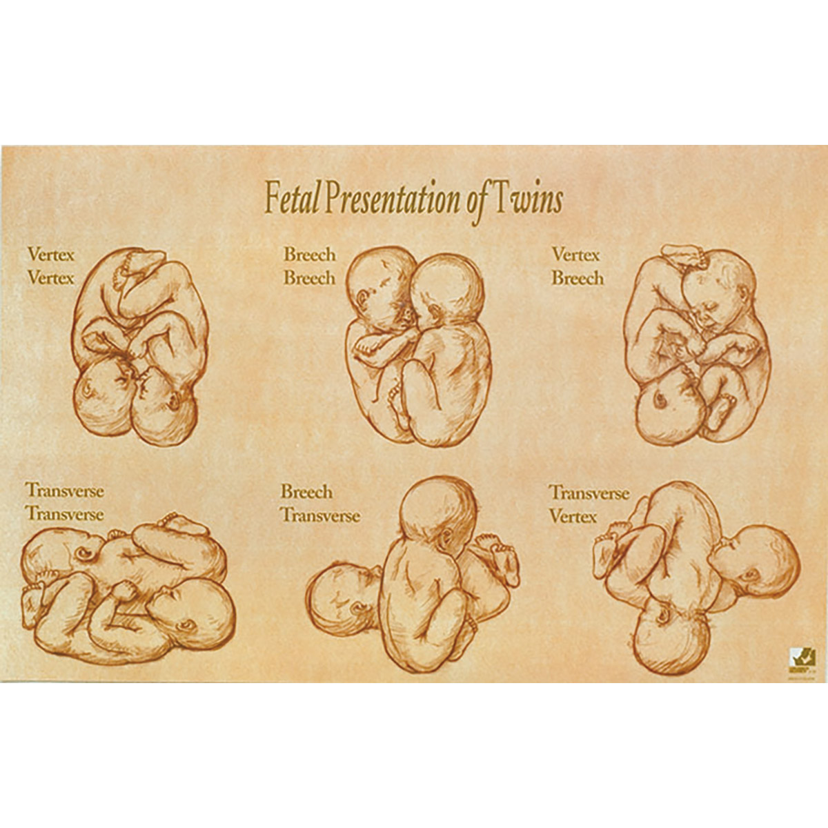 cephalic presentation for twins