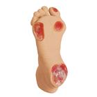 노인성 욕창 발 Elderly Pressure Ulcer Foot, 1013058 [W44757], 욕창간호
