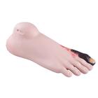 Ulcerated Foot, 1019238 [W45016], Decubitus Care