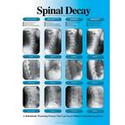 Spinal Decay Chart - Right Facing, Laminated, W57500, Skeletal System
