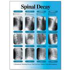 Spinal Decay Chart - Left Facing, Laminated, W57501, Skeletal System